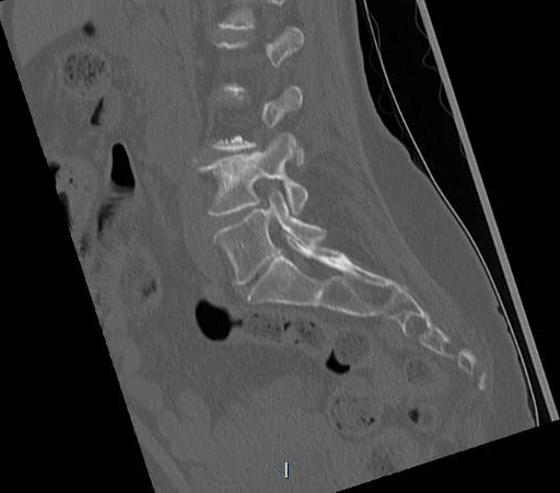 File:Chronic spinal hematoma with cauda equina syndrome (Radiopaedia 75745-88197 Sagittal bone window 10).png