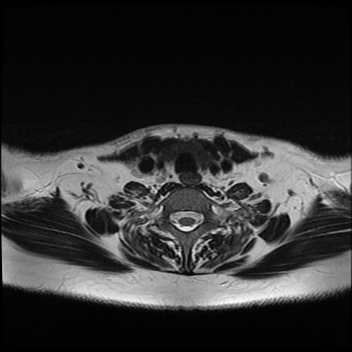 File:Chronic submandibular sialadenitis (Radiopaedia 61852-69885 Axial T2 28).jpg