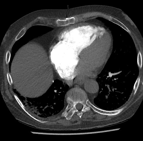 File:Chronic thromboembolic pulmonary disease (Radiopaedia 90694-108119 Axial C+ CTPA 66).jpg