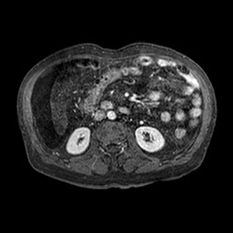 Cirrhosis and hepatocellular carcinoma in the setting of hemochromatosis (Radiopaedia 75394-86594 Axial T1 C+ fat sat 185).jpg