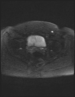 Class II Mullerian duct anomaly- unicornuate uterus with rudimentary horn and non-communicating cavity (Radiopaedia 39441-41755 Axial DWI 53).jpg