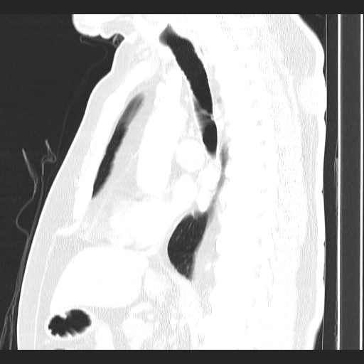 Classic complicated silicosis (Radiopaedia 49720-54961 Sagittal lung window 33).jpg