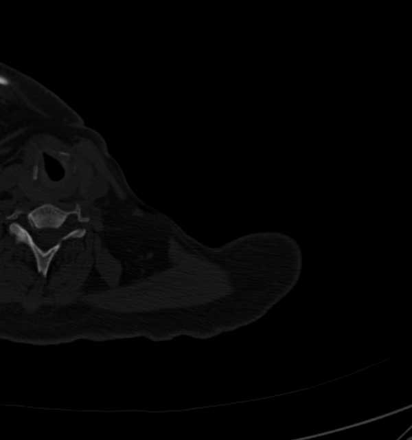 Clear cell chondrosarcoma - humerus (Radiopaedia 63104-71612 Axial bone window 1).jpg