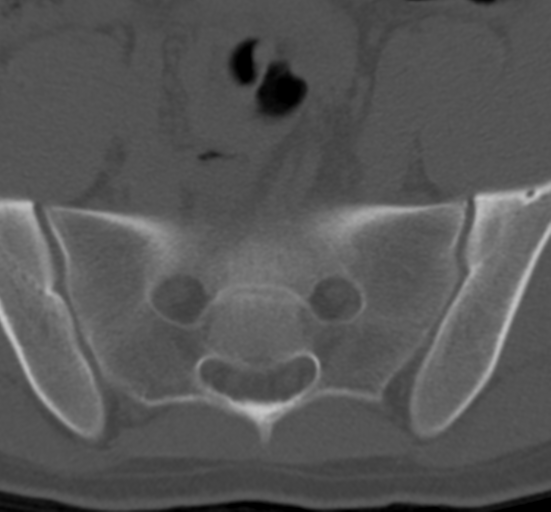 Clear cell meningoma - lumbar spine (Radiopaedia 60116-67691 Axial bone window 75).png