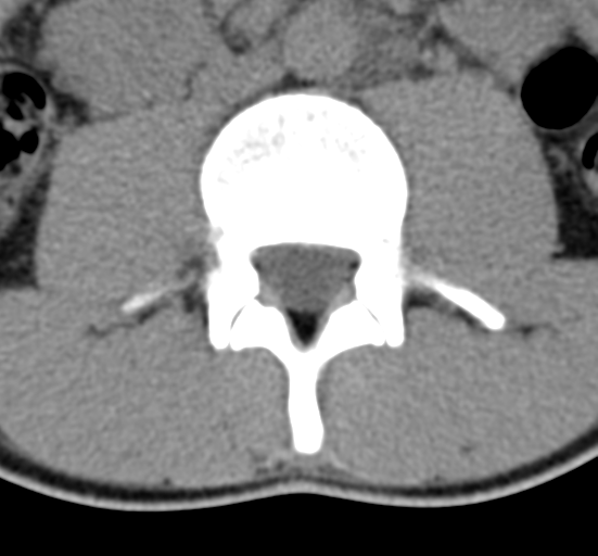 Clear cell meningoma - lumbar spine (Radiopaedia 60116-67691 Axial non-contrast 35).png