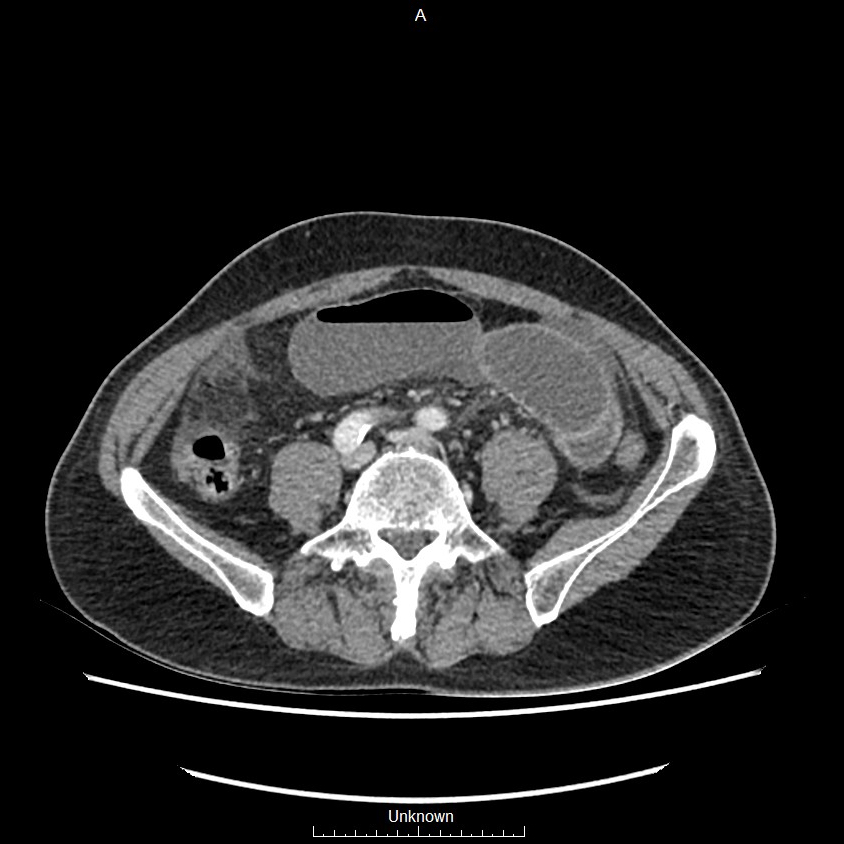 Closed loop bowel obstruction and ischemia (Radiopaedia 86959-103180 A 54).jpg