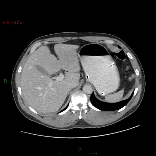 File:Closed loop obstruction and appendicular stump mucocele (Radiopaedia 54014-60163 A 26).jpg