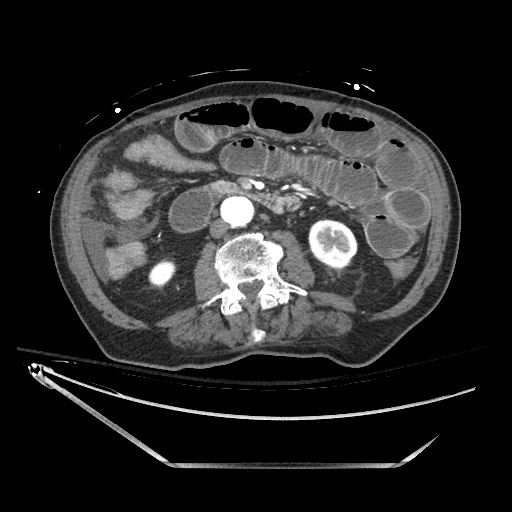 Closed loop obstruction due to adhesive band, resulting in small bowel ischemia and resection (Radiopaedia 83835-99023 B 74).jpg