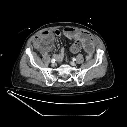 File:Closed loop obstruction due to adhesive band, resulting in small bowel ischemia and resection (Radiopaedia 83835-99023 D 112).jpg