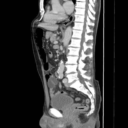 File:Closed loop small bowel obstruction (Radiopaedia 59227-66554 C 35).jpg