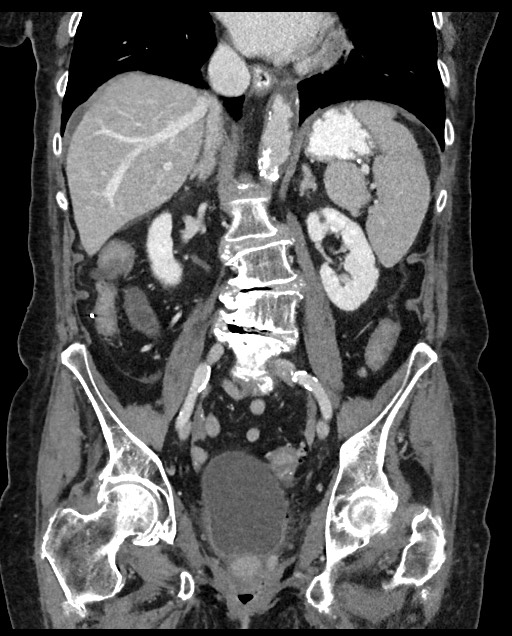 Closed loop small bowel obstruction - adhesions (Radiopaedia 59269-66611 B 71).jpg