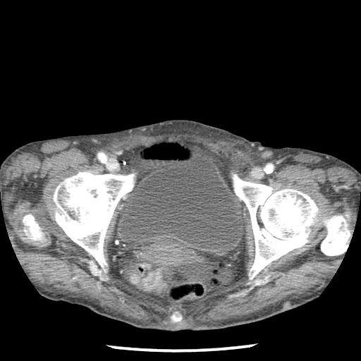 Closed loop small bowel obstruction - adhesions and infarct (Radiopaedia 85125-100678 B 99).jpg