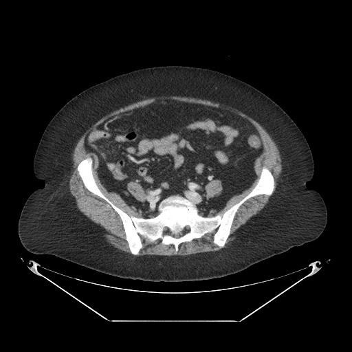 Closed loop small bowel obstruction - internal hernia (Radiopaedia 65402-74450 A 93).jpg