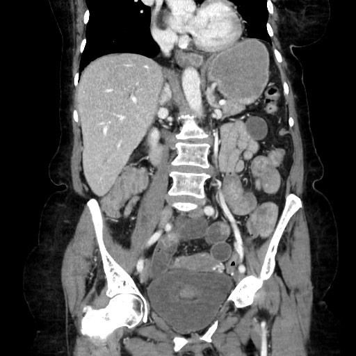 Closed loop small bowel obstruction due to adhesive band, with intramural hemorrhage and ischemia (Radiopaedia 83831-99017 C 65).jpg