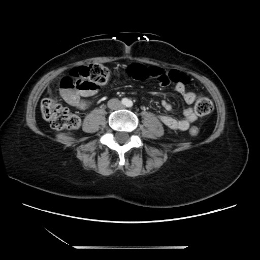 File:Closed loop small bowel obstruction due to adhesive bands - early and late images (Radiopaedia 83830-99014 A 86).jpg