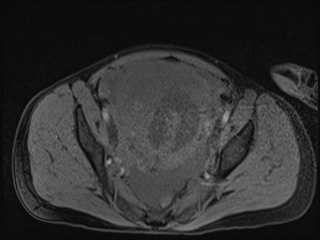 File:Closed loop small bowel obstruction in pregnancy (MRI) (Radiopaedia 87637-104031 G 4).jpg
