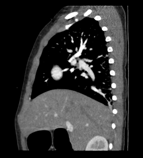 File:Coarctation of aorta (Radiopaedia 27427-27622 Sagittal C+ CTPA 31).png
