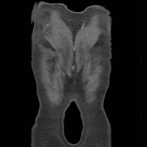 File:Coarctation of the aorta (Radiopaedia 17427-17116 A 6).jpg