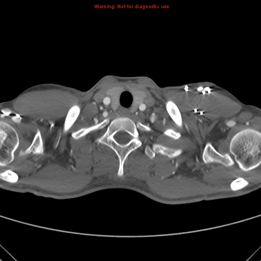 File:Coarctation of the aorta (Radiopaedia 9434-10118 A 8).jpg