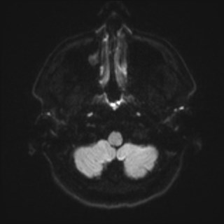 File:Cochlear incomplete partition type III associated with hypothalamic hamartoma (Radiopaedia 88756-105498 Axial DWI 44).jpg