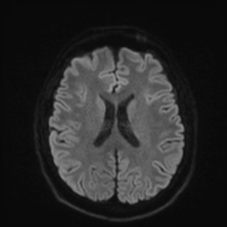 File:Cochlear incomplete partition type III associated with hypothalamic hamartoma (Radiopaedia 88756-105498 Axial DWI 65).jpg
