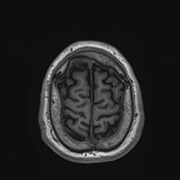 File:Cochlear incomplete partition type III associated with hypothalamic hamartoma (Radiopaedia 88756-105498 Axial T1 171).jpg