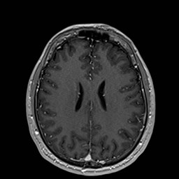 Cochlear incomplete partition type III associated with hypothalamic hamartoma (Radiopaedia 88756-105498 Axial T1 C+ 127).jpg