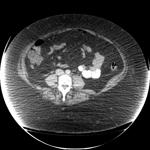 File:Collection due to leak after sleeve gastrectomy (Radiopaedia 55504-61972 A 50).jpg