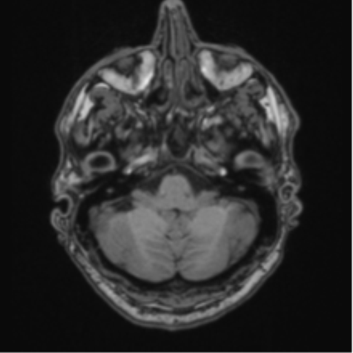 File:Colloid cyst of the third ventricle (Radiopaedia 86571-102662 Axial T1 19).png