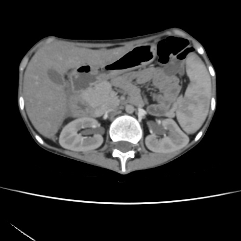 File:Colocolic fistula - Crohn disease (Radiopaedia 57063-63955 A 25).jpg