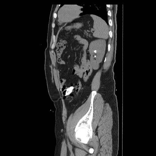 Colocutaneous fistula in Crohn's disease (Radiopaedia 29586-30093 F 40).jpg