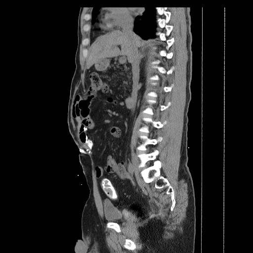 Colocutaneous fistula in Crohn's disease (Radiopaedia 29586-30093 F 9).jpg