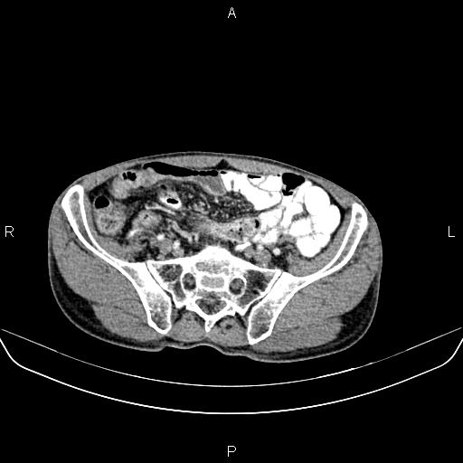 Colon adenocarcinoma - hepatic flexure (Radiopaedia 85635-101395 A 71).jpg