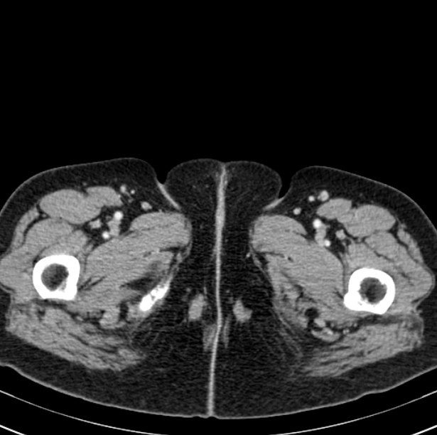 Colon carcinoma with hepatic metastases (Radiopaedia 29477-29961 A 131).jpg