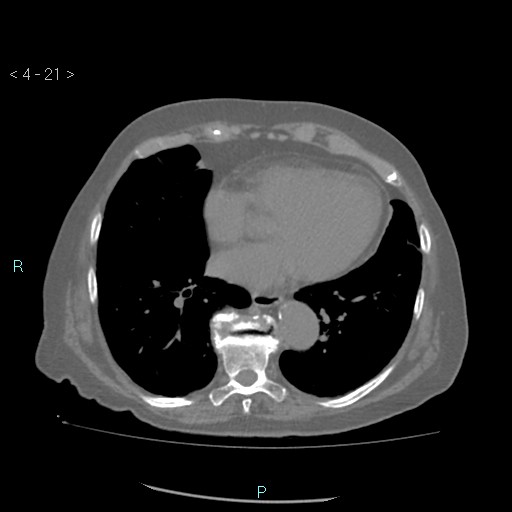 Colonic lipomas (Radiopaedia 49137-54244 Axial bone window 9).jpg