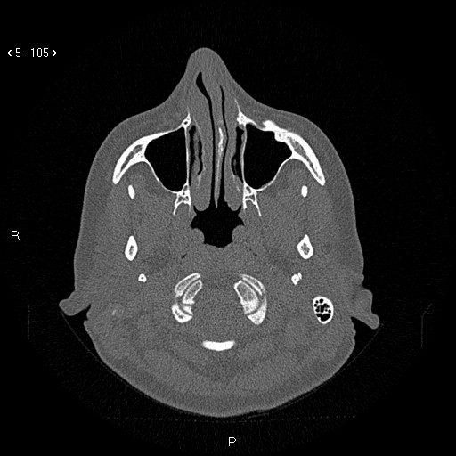 Nasolabial cyst (Radiopaedia 75125-86194 Axial bone window 66).jpg