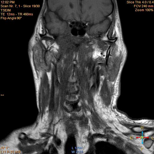 File:Nasopharyngeal carcinoma (Radiopaedia 22375-22403 Coronal T1 10).jpg