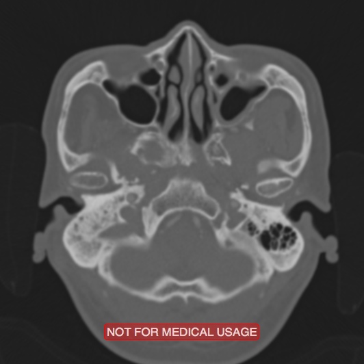 Nasopharyngeal carcinoma recurrence - skull base destruction (Radiopaedia 29107-29490 Axial bone window 90).jpg