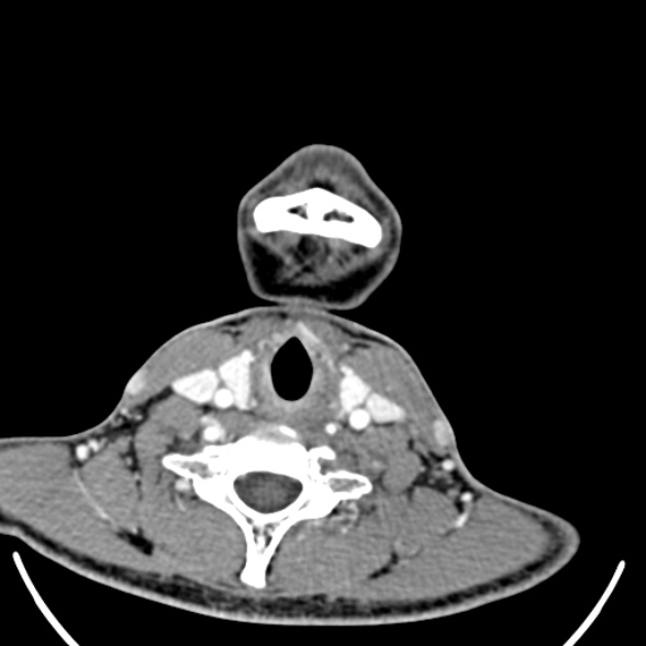 Nasopharyngeal carcinoma with skull base invasion (Radiopaedia 53415-59705 A 160).jpg