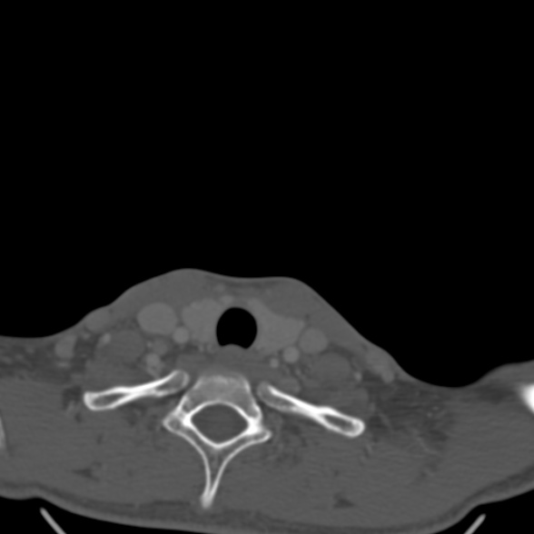 Nasopharyngeal carcinoma with skull base invasion (Radiopaedia 53415-59705 Axial bone window 183).jpg