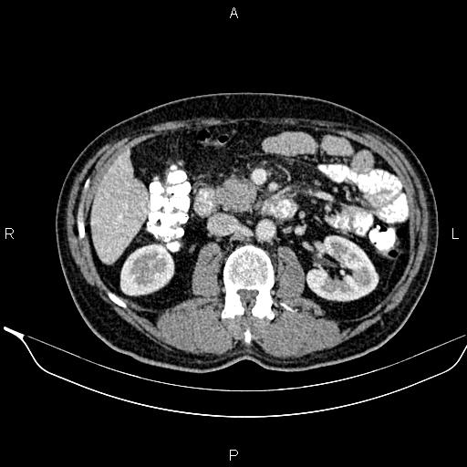 Necrotizing pancreatitis (Radiopaedia 87796-104249 A 25).jpg