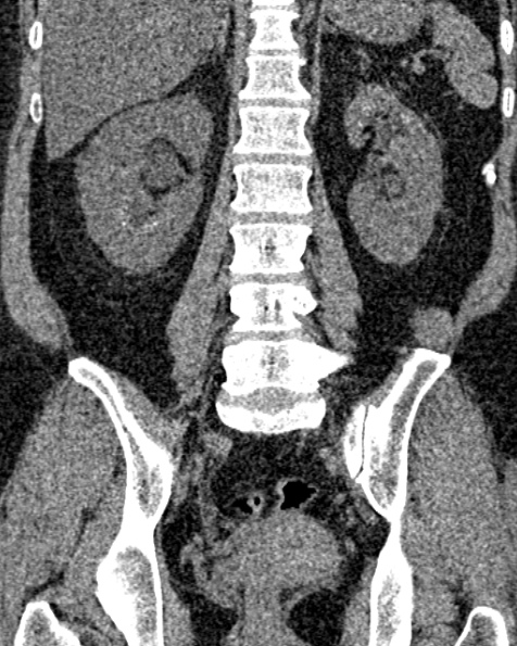 File:Nephrostomy for urosepsis (Radiopaedia 26180-26330 non-contrast 59).jpg