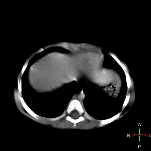 File:Neuroblastoma (Radiopaedia 24751-25016 D 2).jpg