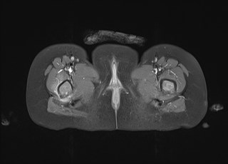 File:Neuroblastoma with bone metastases (Radiopaedia 67080-76414 Axial T1 C+ fat sat 40).jpg