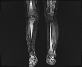 File:Neuroblastoma with bone metastases (Radiopaedia 67080-76414 B 6).jpg