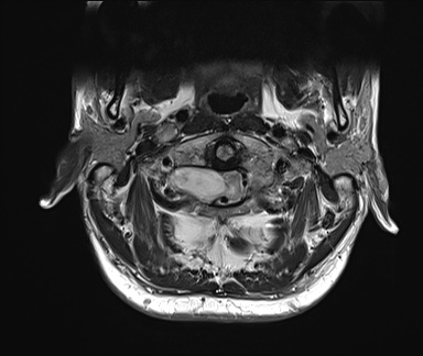 File:Neurofibromatosis type 1 (Radiopaedia 80355-93740 Axial T2 3).jpg