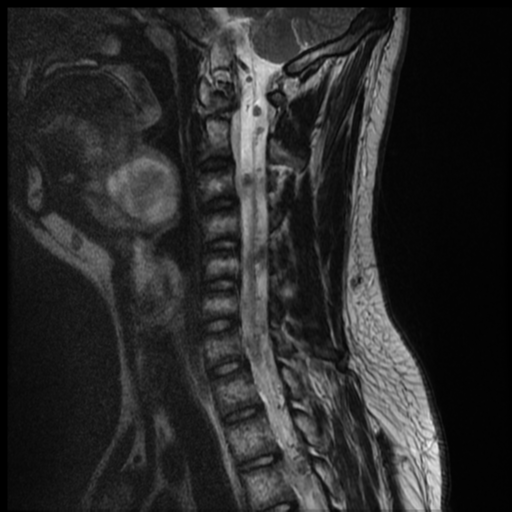 File:Neurofibromatosis type 2 (spinal manifestations) (Radiopaedia 53943-60070 Sagittal T2 8).png
