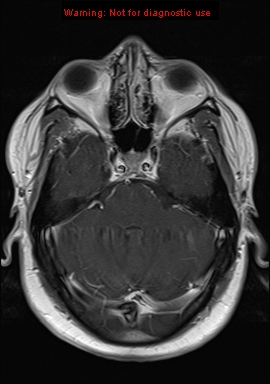 File:Neuroglial cyst (Radiopaedia 10713-11184 Axial T1 C+ 17).jpg