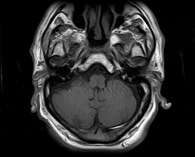 File:Non-Hodgkin lymphoma - parotid gland (Radiopaedia 71531-81890 Axial T1 21).jpg
