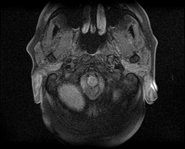 File:Non-Hodgkin lymphoma - parotid gland (Radiopaedia 71531-81890 T1 fat sat 18).jpg